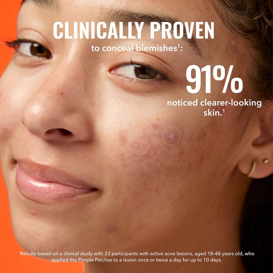 pimple-patches-q0 zb_p.jpg