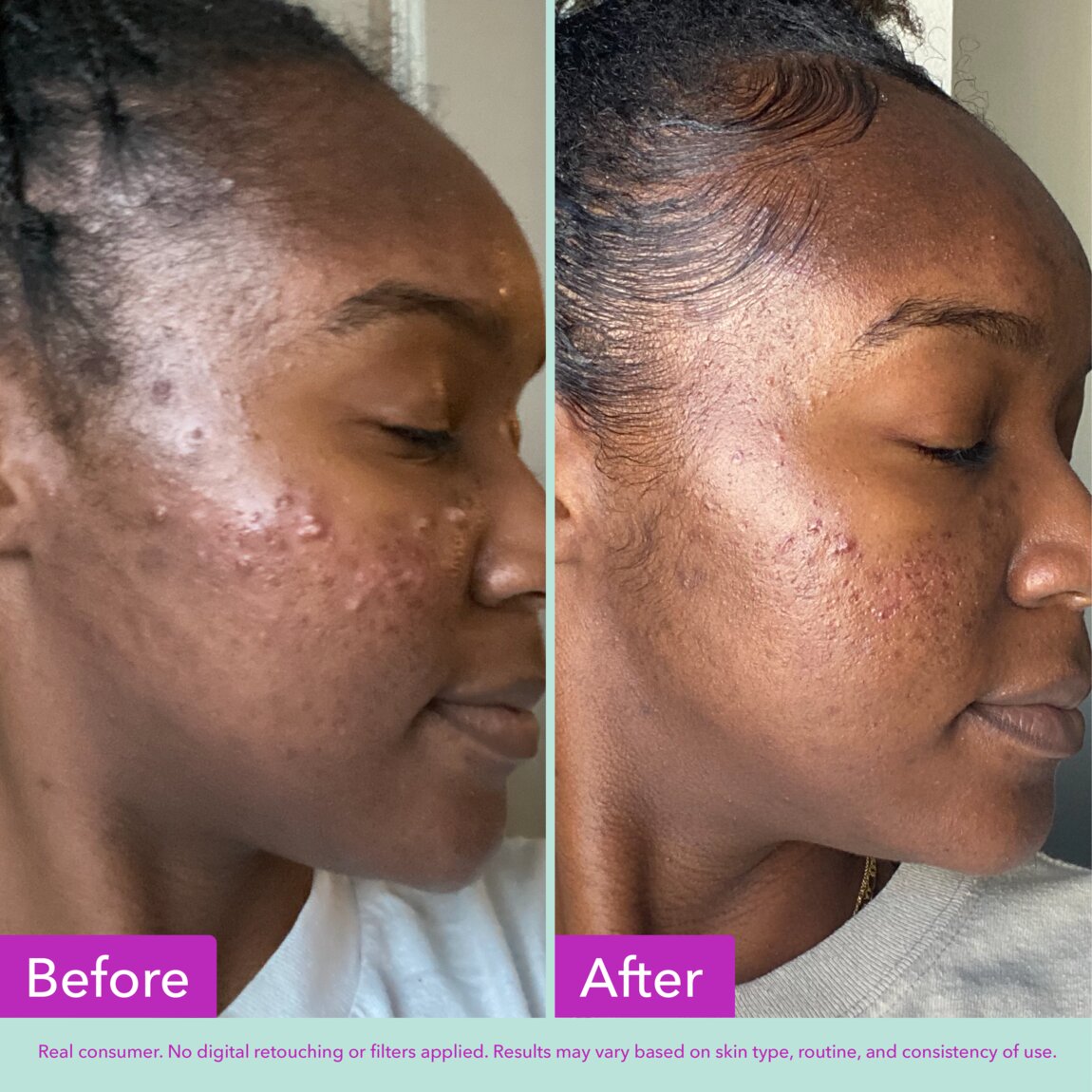 acne-foaming-cleanser-x9 zb_p.jpg
